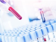 Xét nghiệm mẫu máu để chẩn đoán sớm sáu loại ung thư 